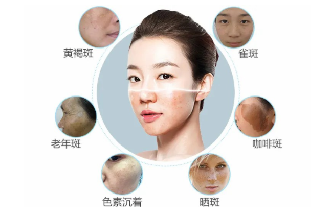 微晶祛斑是不是容易引起复发？注意事项都有什么？