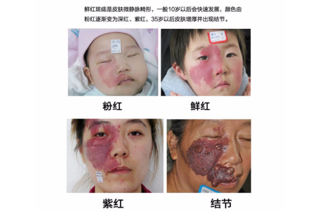 鲜红斑痣是如何分型定级的？一起来学习下吧